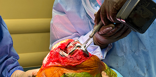 knee replacement